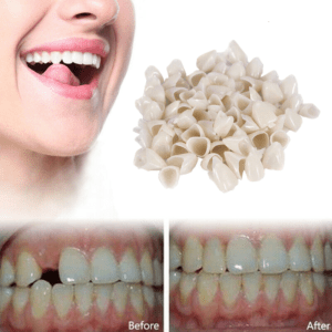 Temporary Dental Crowns & Veneers Guide